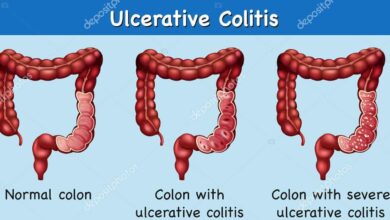 Ulcerative Colitis
