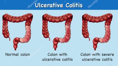 Ulcerative Colitis