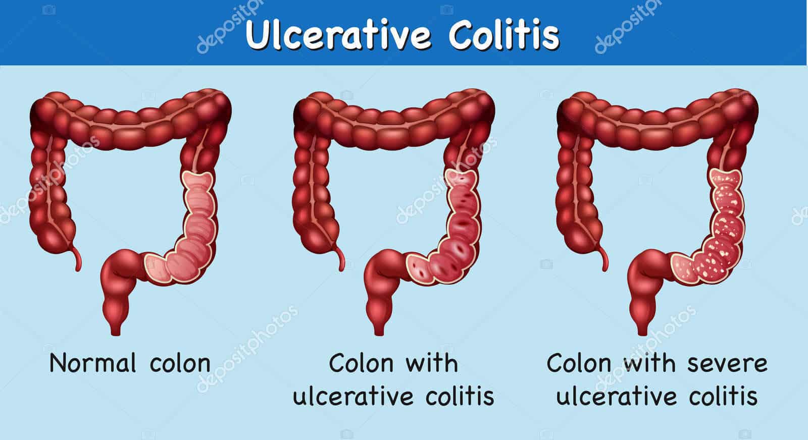 Ulcerative Colitis