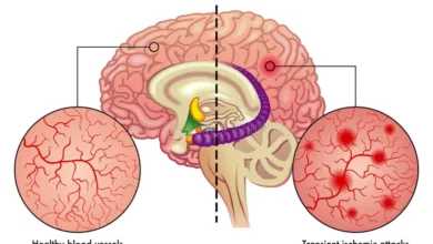 Vascular Dementia