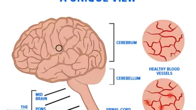 Vascular Dementia