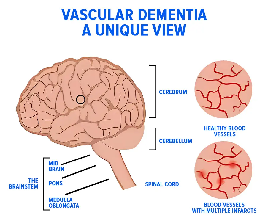 Vascular Dementia