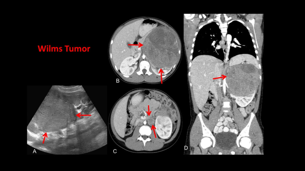 Wilms Tumor (Nephroblastoma): The Kidney Cancer Found in Children