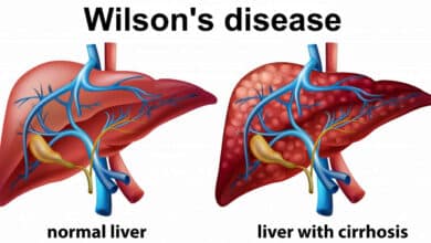 Wilson's Disease