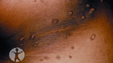 Acanthosis Nigricans