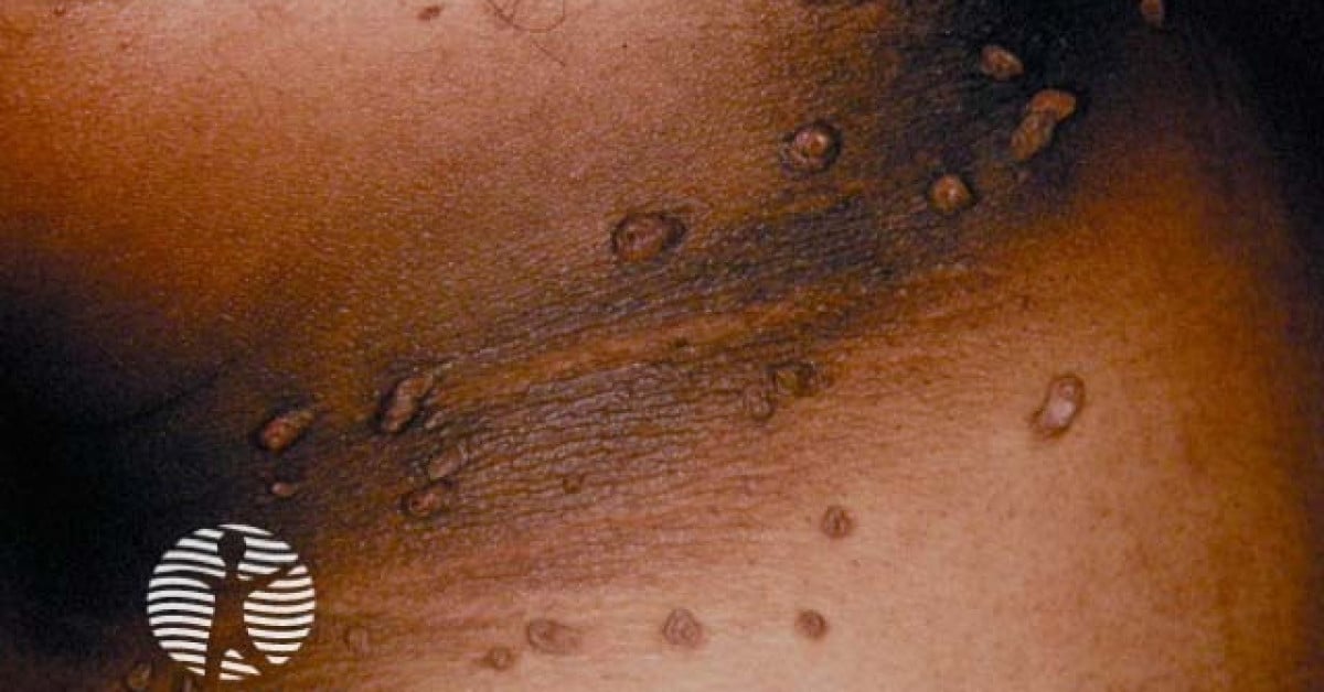 Acanthosis Nigricans