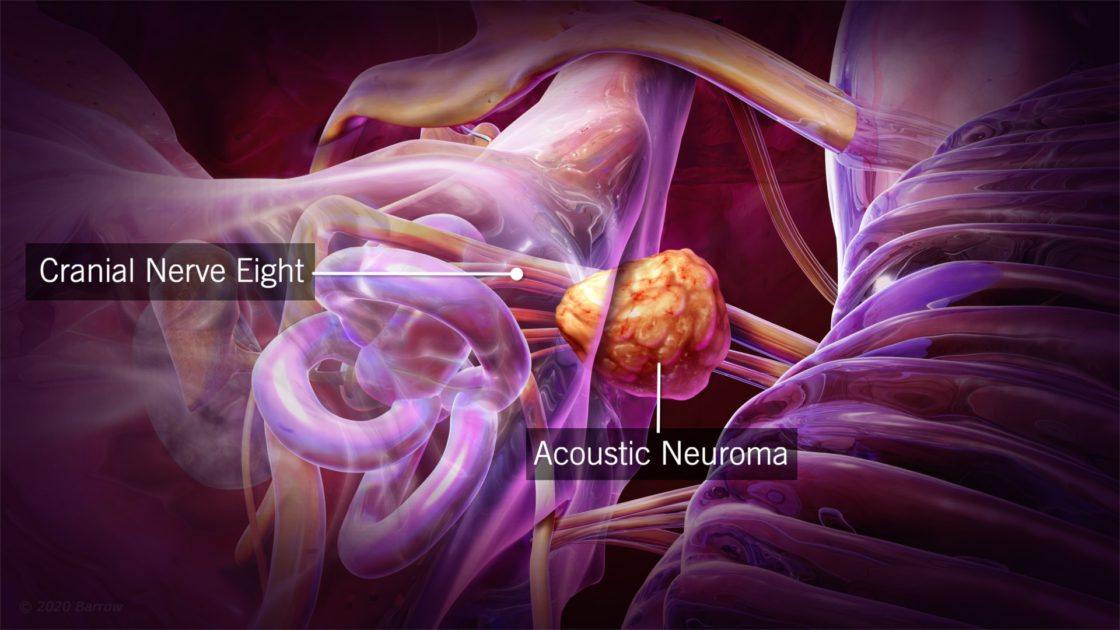 Acoustic Neuroma (Vestibular Schwannoma)