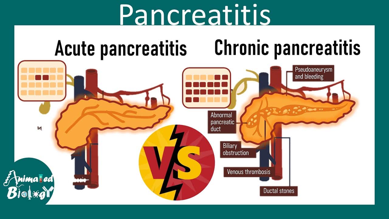 Acute Pancreatitis vs Chronic Pancreatitis