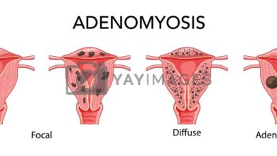 Adenomyosis