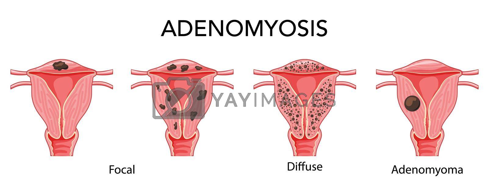 Adenomyosis