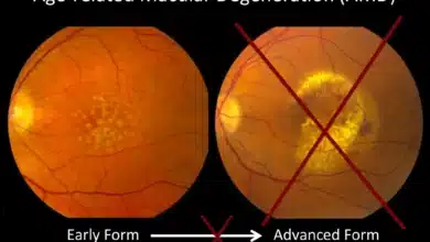 Age-Related Macular Degeneration