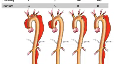 Aortic Dissection
