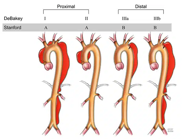 Aortic Dissection