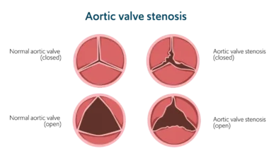 Aortic Stenosis