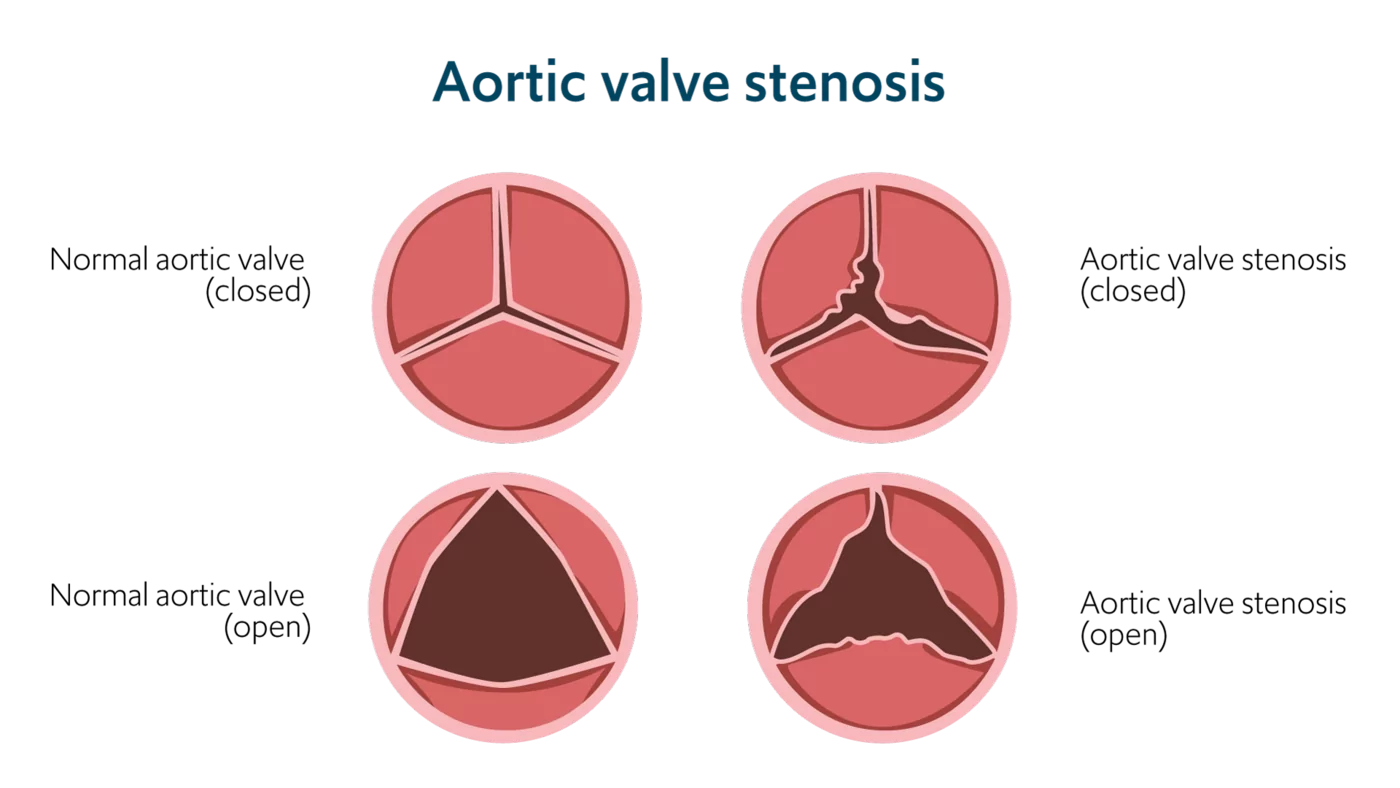 Aortic Stenosis