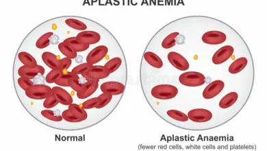 Aplastic Anemia