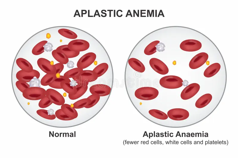 Aplastic Anemia