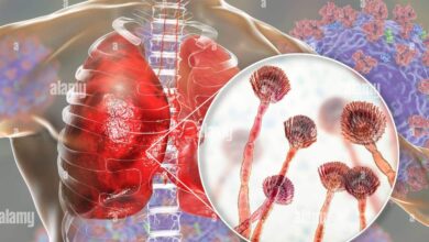 Aspergillosis