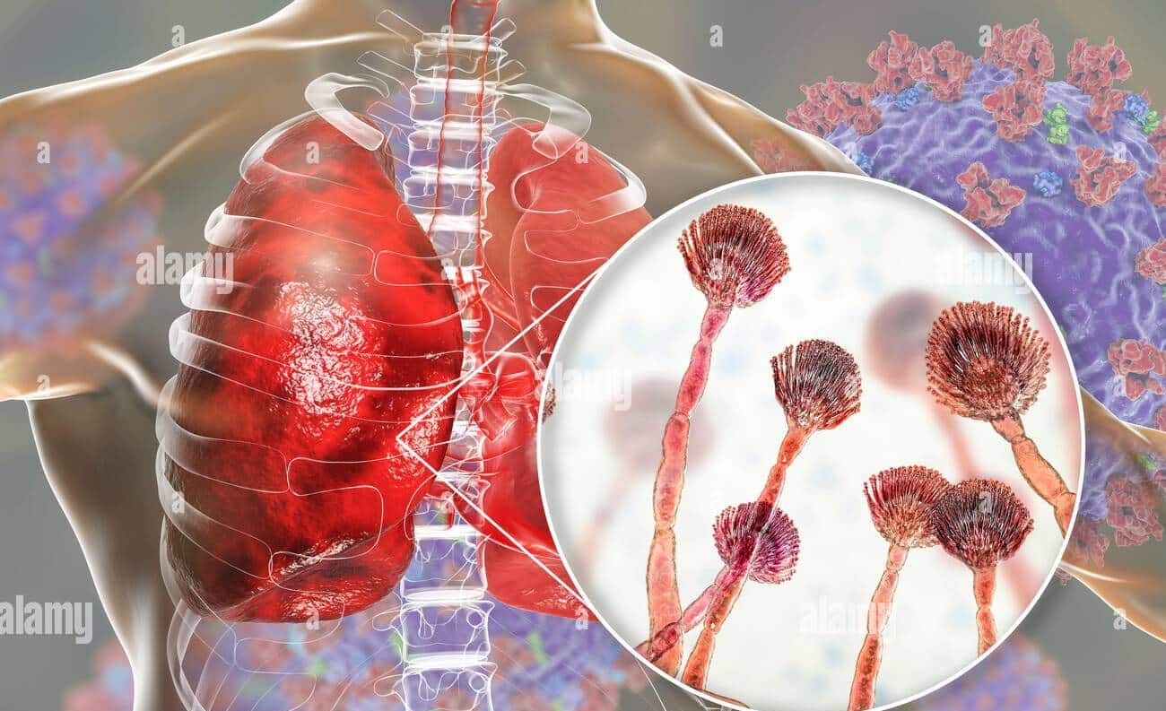 Aspergillosis