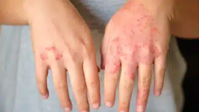 Atopic Dermatitis (Eczema)