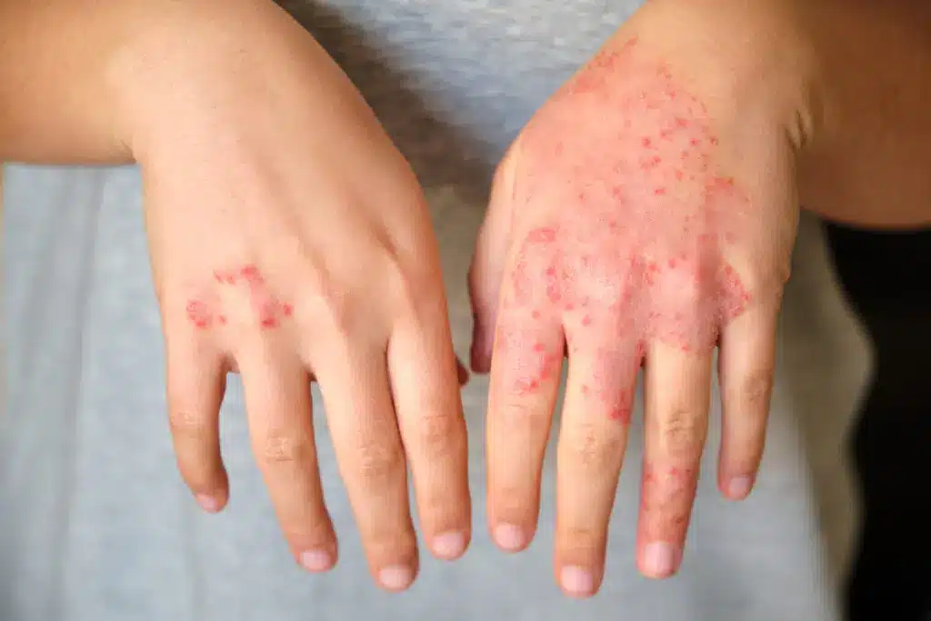 Atopic Dermatitis (Eczema)