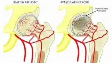 Avascular Necrosis