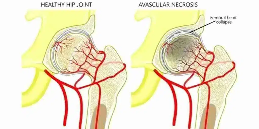Avascular Necrosis