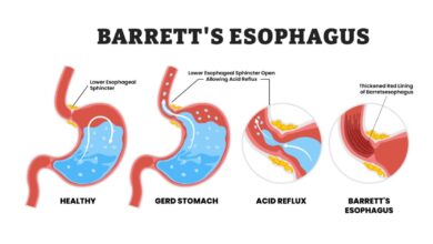 Barrett's Esophagus