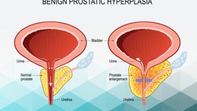 Benign Prostatic Hyperplasia