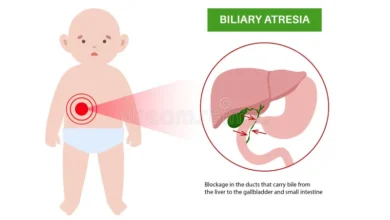 Biliary Atresia