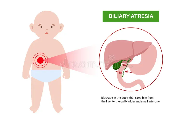 Biliary Atresia
