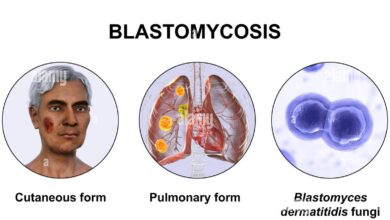 Blastomycosis