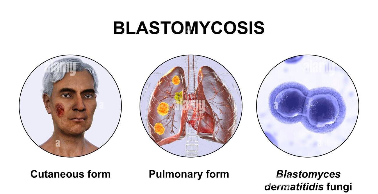 Blastomycosis