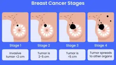 Breast Cancer