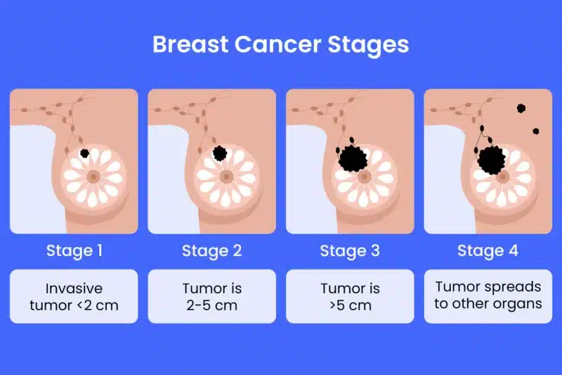 Breast Cancer