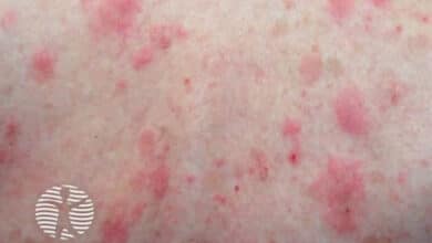 Bullous Pemphigoid