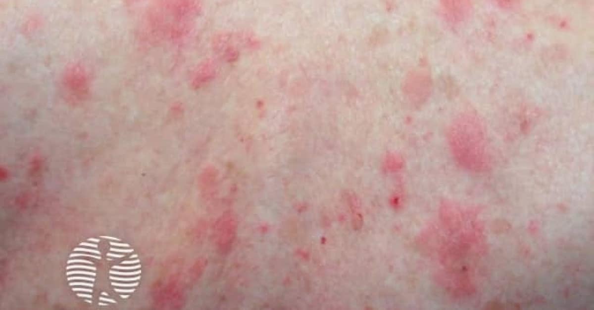 Bullous Pemphigoid