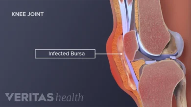 Bursitis