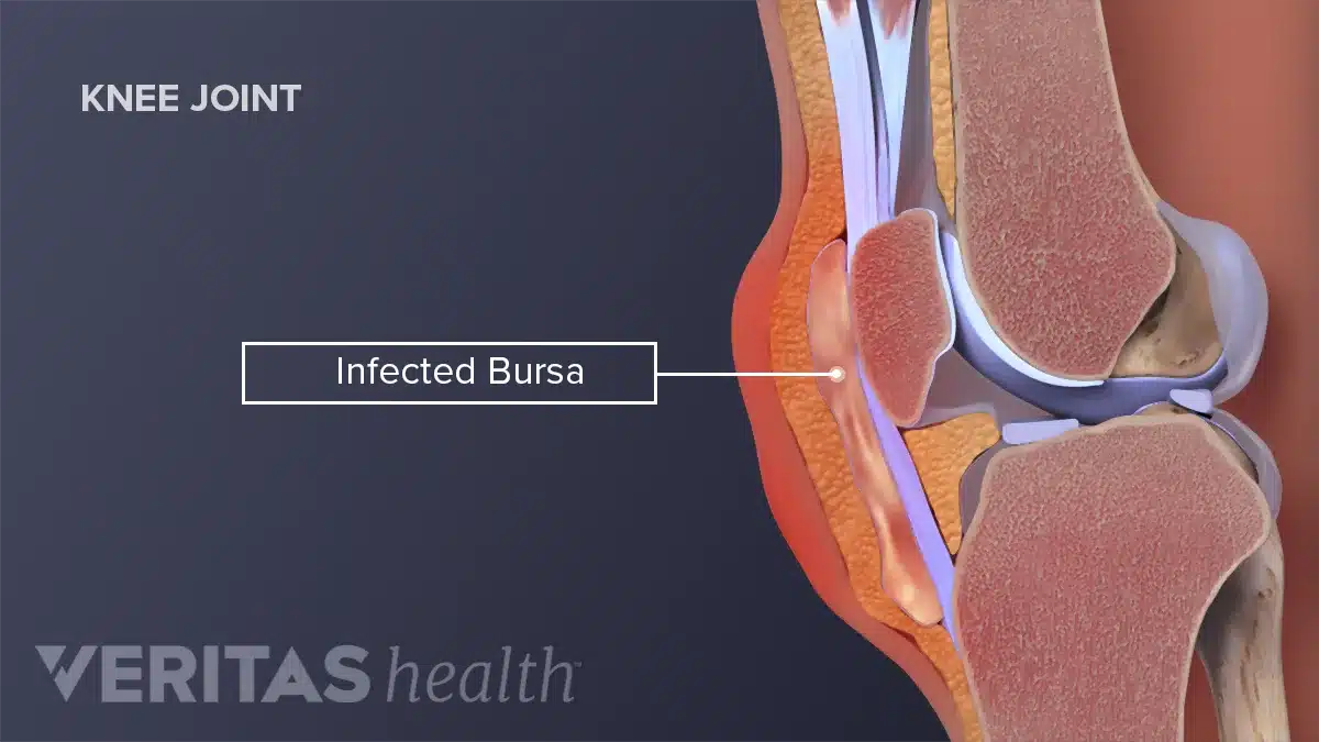 Bursitis