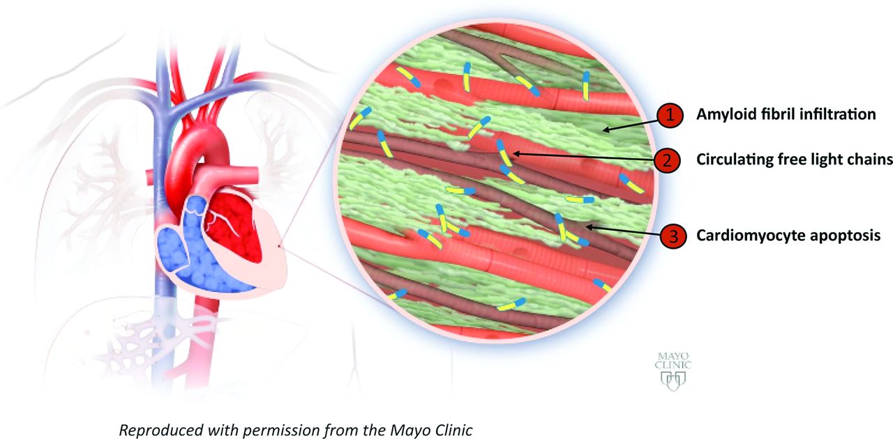 Cardiac Amyloidosis