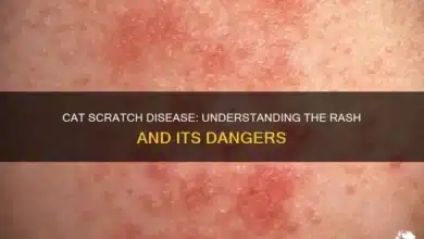 Cat Scratch Disease