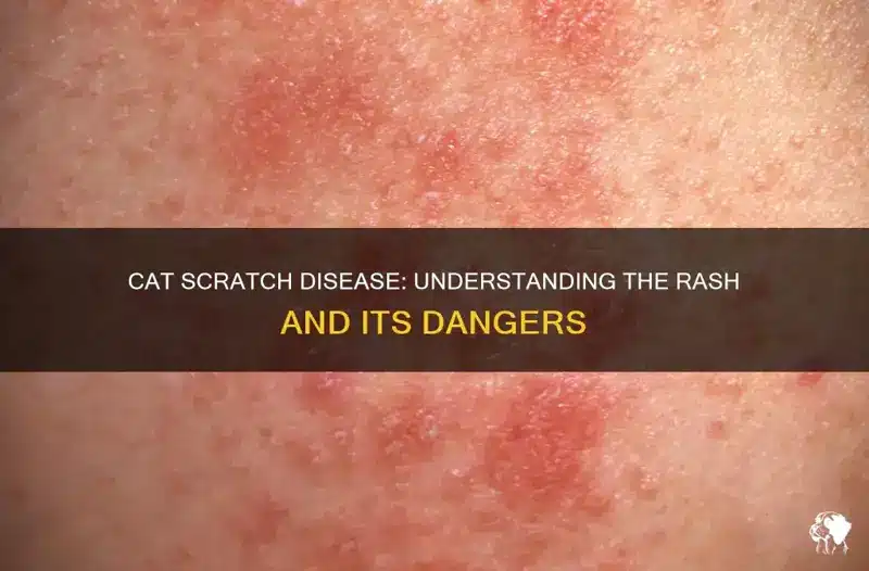Cat Scratch Disease