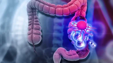 Colon Cancer Symptoms in Young Adults