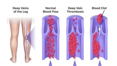 Deep Vein Thrombosis (DVT)