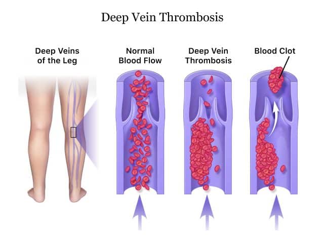Deep Vein Thrombosis (DVT)