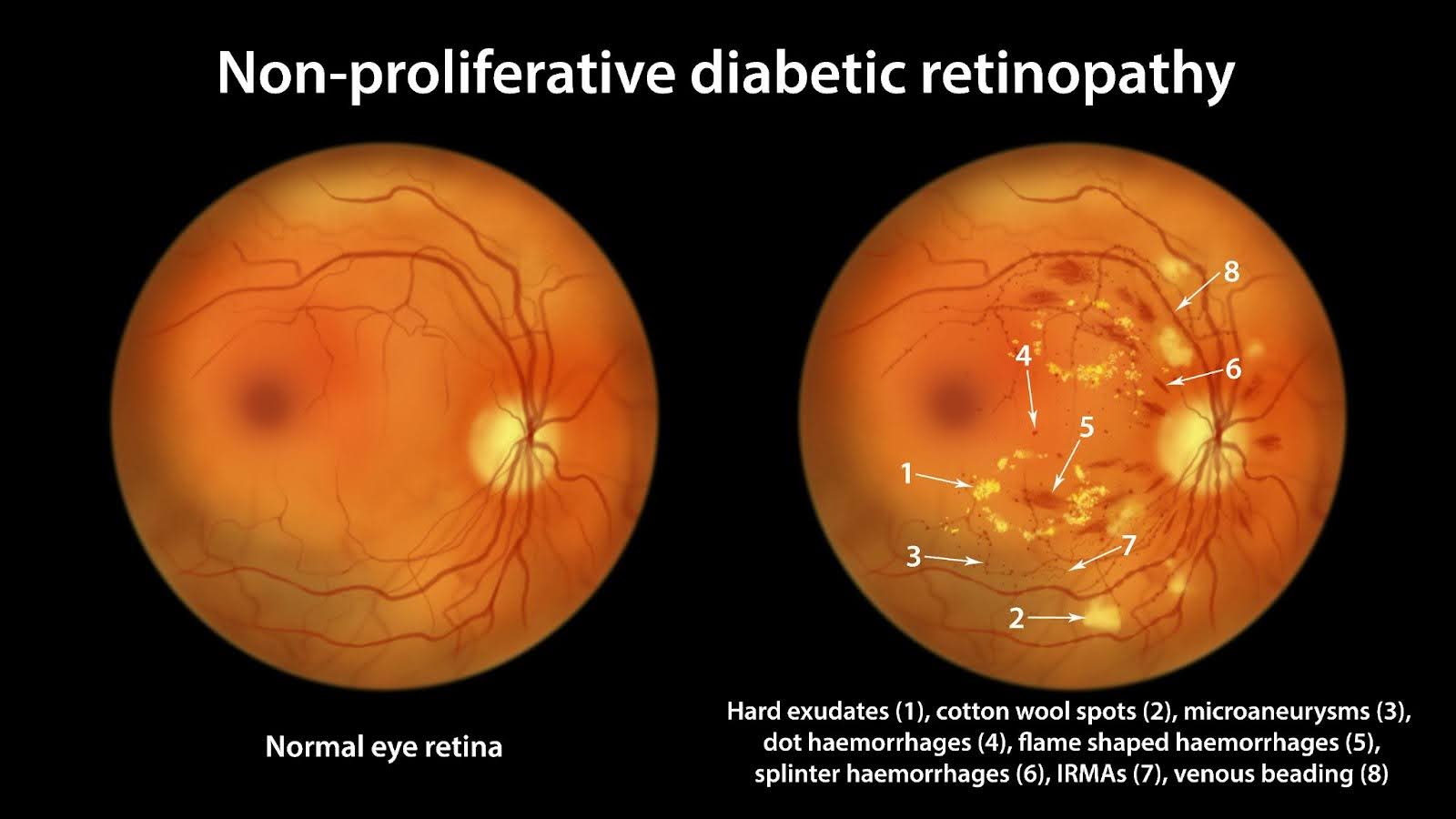 Diabetic Retinopathy