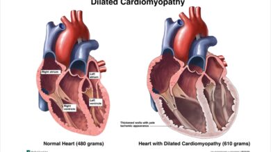 Dilated Cardiomyopathy
