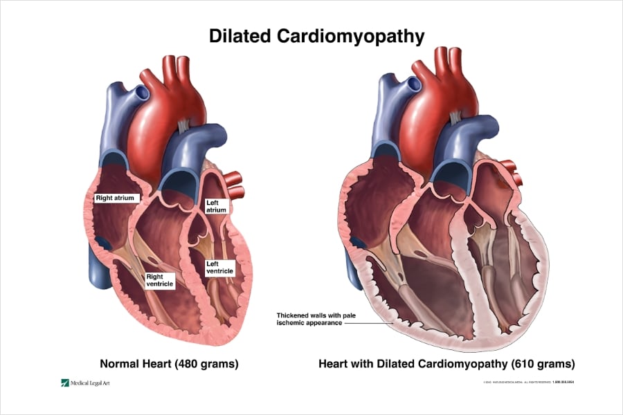 Dilated Cardiomyopathy
