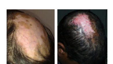Discoid Lupus Erythematosus