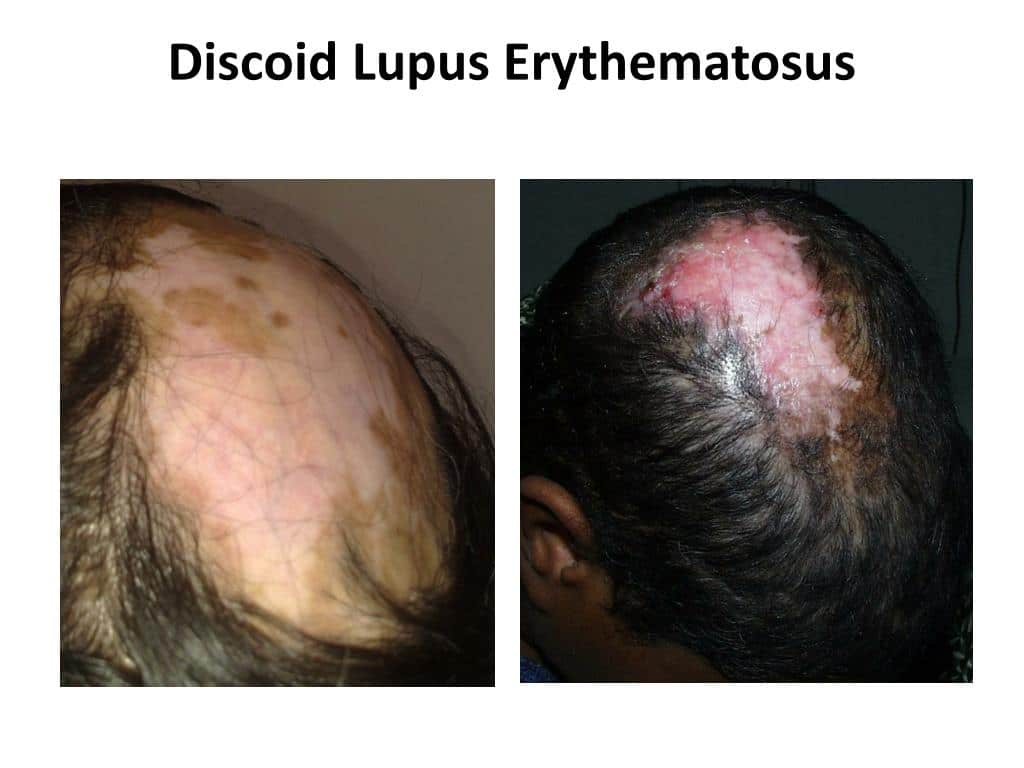 Discoid Lupus Erythematosus